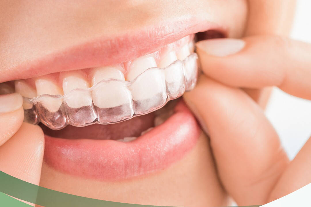 Cosmetic dentistry is dental work that improves the appearance of your teeth, gums or bite. For those looking to straighten their teeth, for example, Invisalign offers a clear, removable aligner – an alternative ti traditional braces. Facebook / Dolynchuk Dental Center